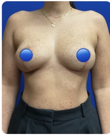 After Image: Breast Explant Surgery and Lift: 5 Weeks Post Op - front