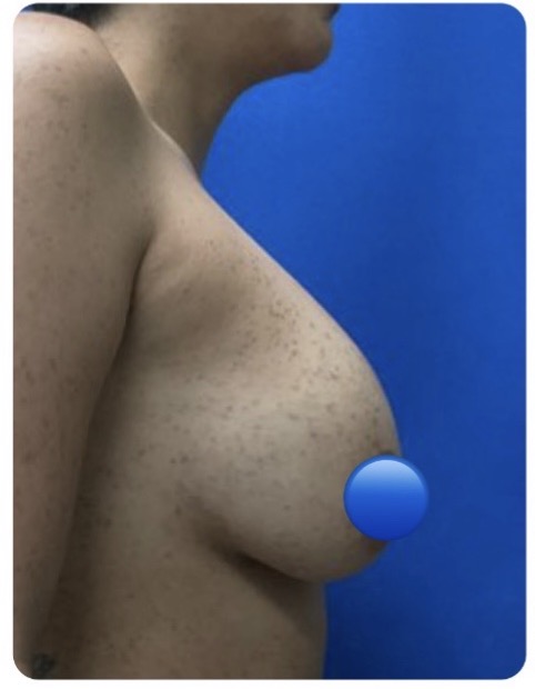 Before Image: Breast Explant Surgery and Lift: 5 Weeks Post Op - right-side