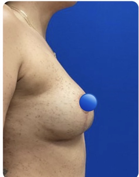After Image: Breast Explant Surgery and Lift: 5 Weeks Post Op - right-side