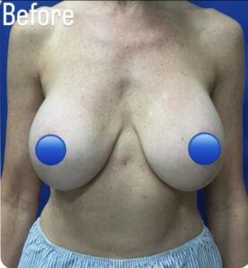Before Image: Breast Explant Surgery and Lift: 5 Months Post Op