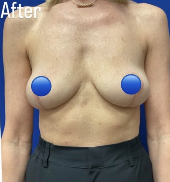 After Image: Breast Explant Surgery and Lift: 5 Months Post Op - front