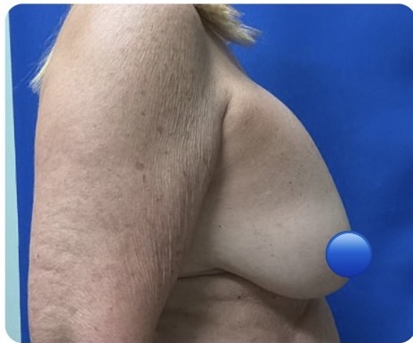 Before Image: Breast Explant Surgery and Lift: 2.5 Months Post Op - right-side