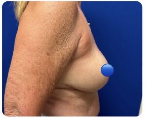 After Image: Breast Explant Surgery and Lift: 2.5 Months Post Op