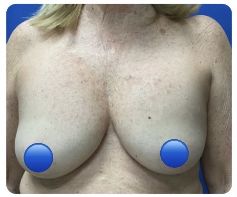 Before Image: Breast Explant Surgery and Lift: 2.5 Months Post Op - front
