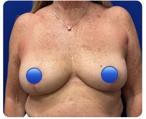 After Image: Breast Explant Surgery and Lift: 2.5 Months Post Op - front