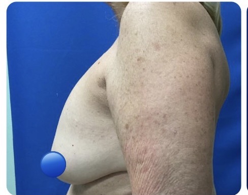 Before Image: Breast Explant Surgery and Lift: 2.5 Months Post Op - left-side