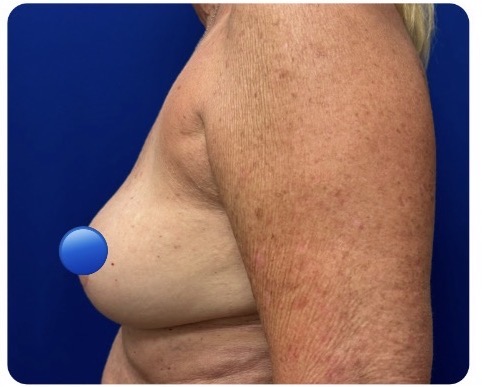 After Image: Breast Explant Surgery and Lift: 2.5 Months Post Op - left-side