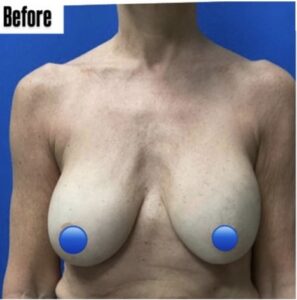 Before Image: Breast Explant Surgery: 1 Month Post Op