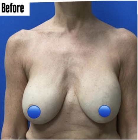 Before Image: Breast Explant Surgery: 1 Month Post Op - front