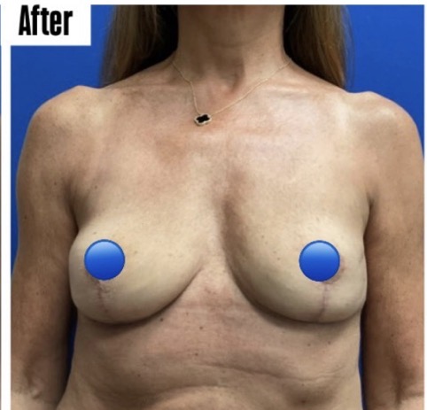 After Image: Breast Explant Surgery: 1 Month Post Op - front