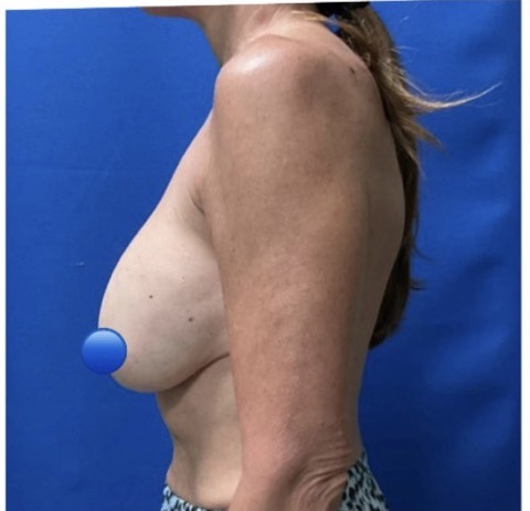 Before Image: Breast Explant Surgery: 1 Month Post Op - left-side