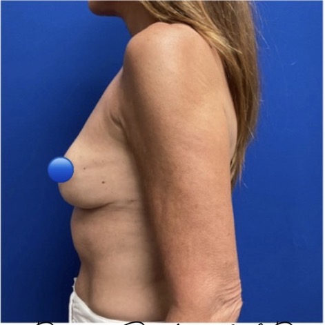 After Image: Breast Explant Surgery: 1 Month Post Op - left-side