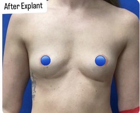 Before Image: Fat Transfer to the Breasts - front
