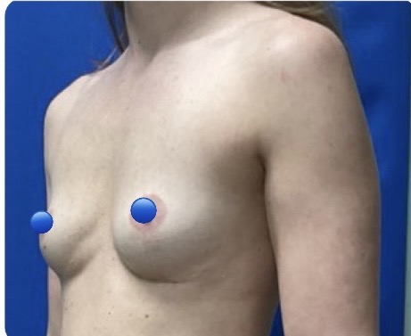 Before Image: Fat Transfer to the Breasts - left-front-oblique