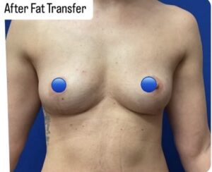 After Image: Fat Transfer to the Breasts