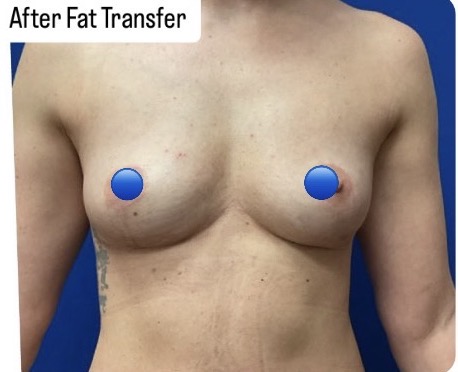 After Image: Fat Transfer to the Breasts - front
