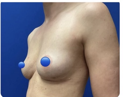 After Image: Fat Transfer to the Breasts - left-front-oblique