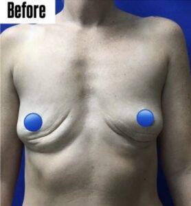 Before Image: Fat Transfer to the Breasts