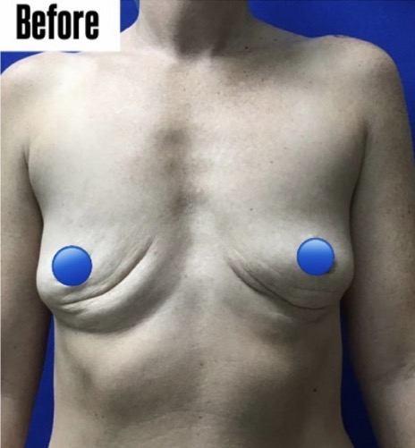 Before Image: Fat Transfer to the Breasts - front