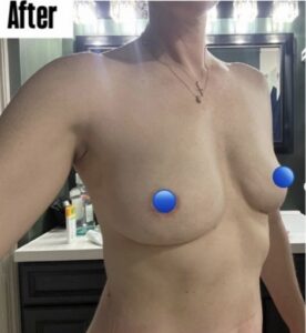 After Image: Fat Transfer to the Breasts