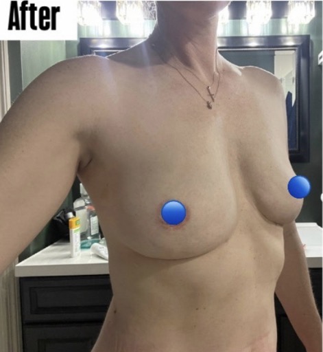 After Image: Fat Transfer to the Breasts - front