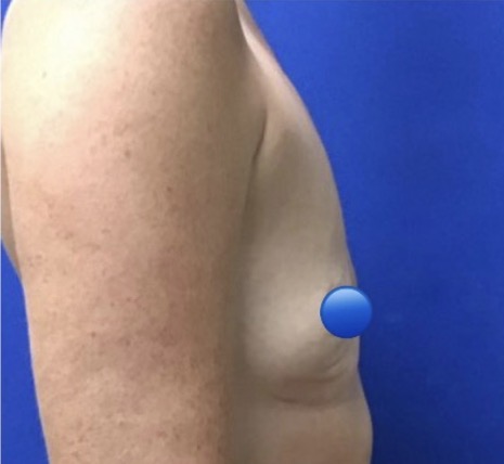 Before Image: Fat Transfer to the Breasts - right-side