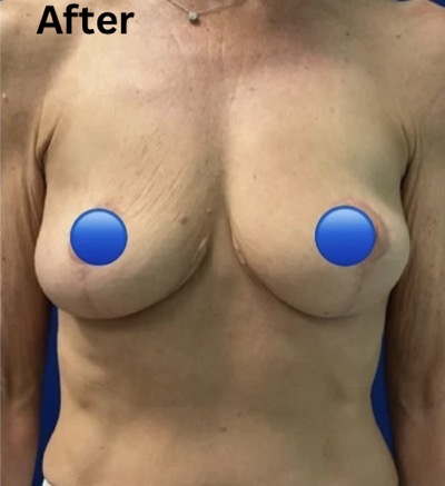 After Image: Breast Explant Surgery: 6 Weeks Post Op - 