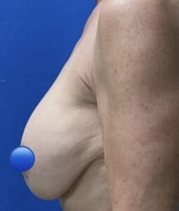 Before Image: Breast Explant Surgery: 6 Weeks Post Op