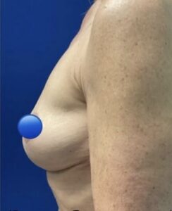 After Image: Breast Explant Surgery: 6 Weeks Post Op