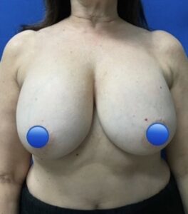 Before Image: Breast Explant Surgery: 4 Weeks Post Op