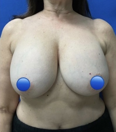 Before Image: Breast Explant Surgery: 4 Weeks Post Op - front