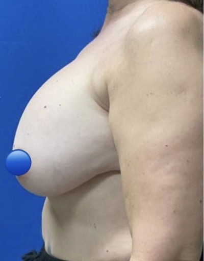 Before Image: Breast Explant Surgery: 4 Weeks Post Op - left-side