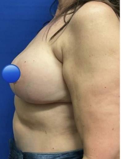 After Image: Breast Explant Surgery: 4 Weeks Post Op - left-side