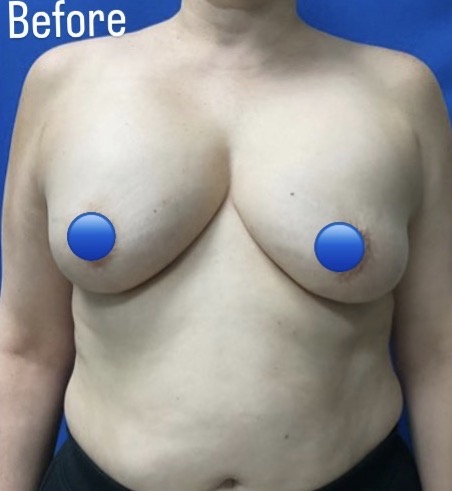 Before Image: Breast Explant Surgery: 6 Weeks Post Op - front