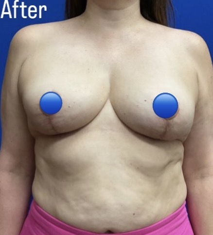 After Image: Breast Explant Surgery: 6 Weeks Post Op - front