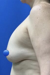 Before Image: Breast Explant Surgery: 6 Weeks Post Op