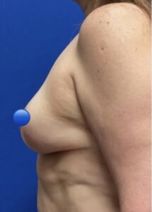 After Image: Breast Explant Surgery: 6 Weeks Post Op