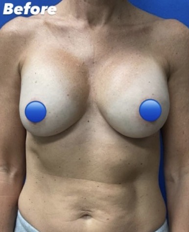 Before Image: Breast Explant Surgery: 6 Months Post Op - front