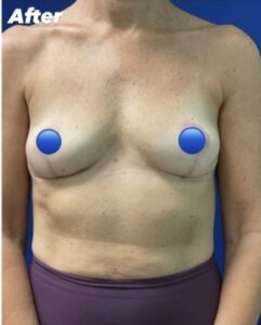 After Image: Breast Explant Surgery: 6 Months Post Op