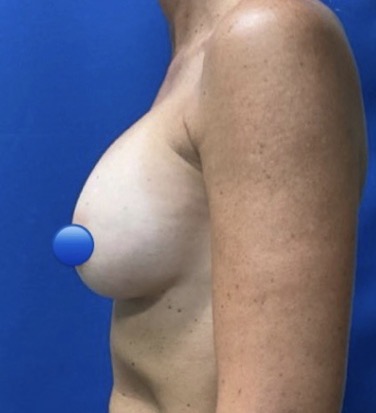 Before Image: Breast Explant Surgery: 6 Months Post Op - left-side