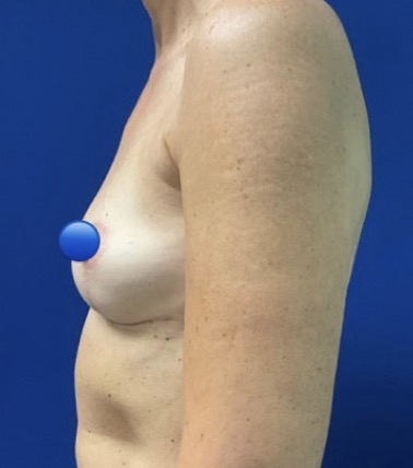 After Image: Breast Explant Surgery: 6 Months Post Op - left-side