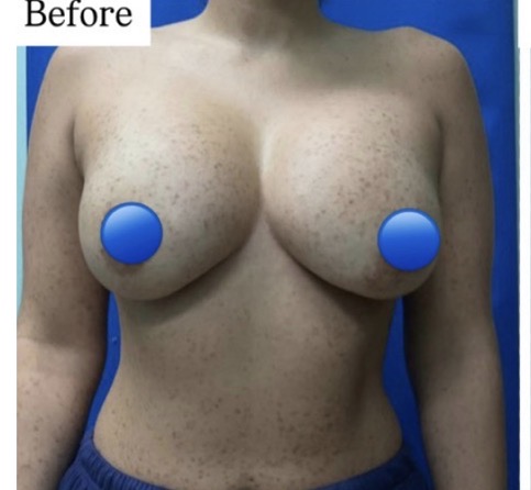 Before Image: Breast Explant Surgery: 6 Months Post Op - front
