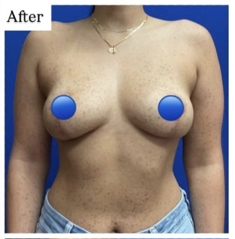After Image: Breast Explant Surgery: 6 Months Post Op - front