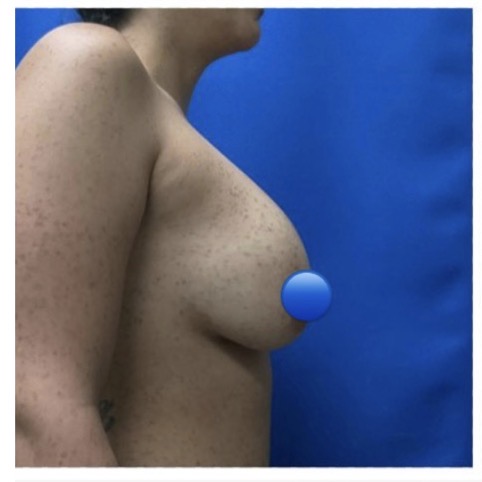 Before Image: Breast Explant Surgery: 6 Months Post Op - right-side