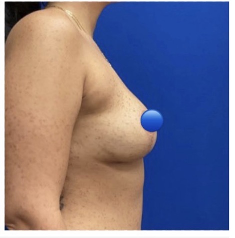 After Image: Breast Explant Surgery: 6 Months Post Op - right-side