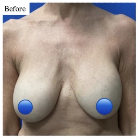 Before Image: Breast Explant Surgery: 3 Months Post Op - front