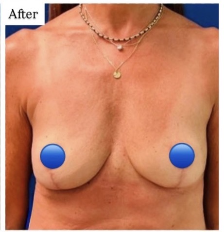 After Image: Breast Explant Surgery: 3 Months Post Op - front