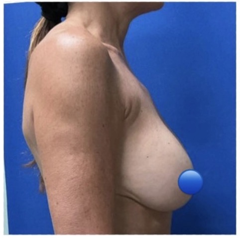 Before Image: Breast Explant Surgery: 3 Months Post Op - right-side