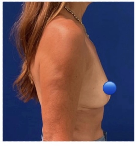 After Image: Breast Explant Surgery: 3 Months Post Op - right-side