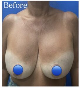 Before Image: Breast Explant Surgery: 8 Months Post Op